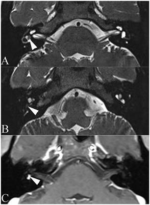 Endolymphatic Hydrops in Patients With Intralabyrinthine Schwannomas